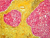 Breast cancer,light micrograph