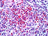 Hodgkin's lymphoma,light micrograph