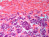 Secondary liver cancer,light micrograph