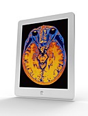 Tablet computer showing MRI brain scan
