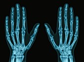 Hands,X-ray