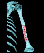 Pinned arm fracture,3D CT scan