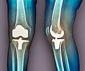 Total knee replacement,X-rays