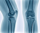 Healthy knee,X-ray