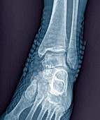 Healthy ankle joint,X-ray
