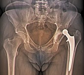 Dislocated hip replacement,X-ray
