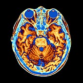 Coloured MRI scan of the human head