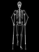 Skeleton on crutches,artwork