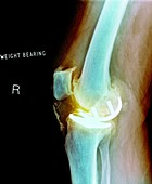 Osteoarthritis of the knee,X-ray