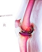 Osteoarthritis of the knee,X-ray