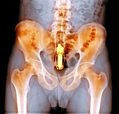 Foreign object in rectum,X-ray