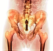 Foreign object in rectum,X-ray