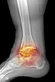 Osteoarthritis of the ankle,X-ray