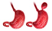 Human stomach with hernia,artwork