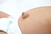 Baby with umbilical hernia