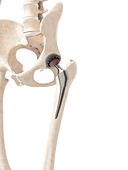 Human hip replacement,artwork