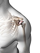 Human shoulder replacement,artwork