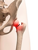 Broken hip bone,illustration