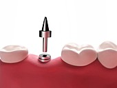 Dental implant,illustration