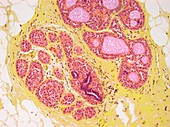 Abnormal breast cells,light micrograph