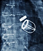 Artificial heart valves,X-ray