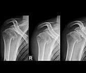Injured shoulder,X-rays