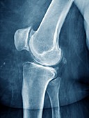 Arthritis of the knee,X-ray