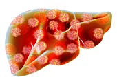 Human liver with hepatitis viruses