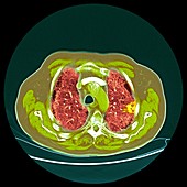 Lung cancer,CT scan