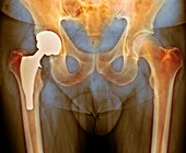Total hip replacement,X-ray