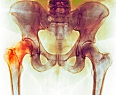 Hip before hip replacement surgery,X-ray