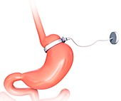 Human gastric band,illustration