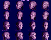 3-D CT scans of mummy head