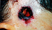 Fatal bullet wound in head