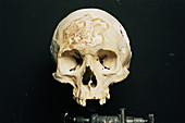 Skull during forensic research
