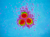 Coloured TEM of Varicella-zoster virus particles