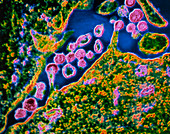 TEM showing particles of HIV