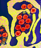 Coloured TEM of HHV6 infecting a cell
