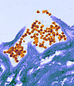 Human papilloma virus particles,TEM