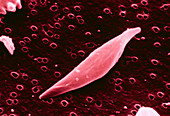 SEM of sickle cell anaemia