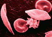 Sickle cell anaemia