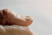 Thumb of sufferer of iron-deficiency anaemia
