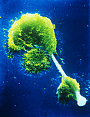 SEM of macrophages impaled on an asbestos needle