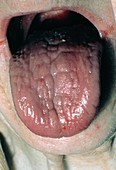 Tongue in iron-deficiency anaemia