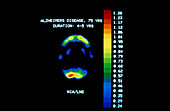 PET scan of brain in Alzheimer's disease
