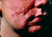 Severe acne scarring over an adolescent boy's face
