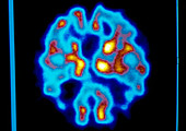 PET scan (basal ganglia) of Alzheimer's disease