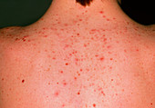 Acne vulgaris on the back of a young man