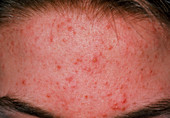 Acne vulgaris on the forehead of a young patient