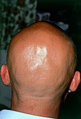 Alopecia areata (hair loss) over the scalp of man